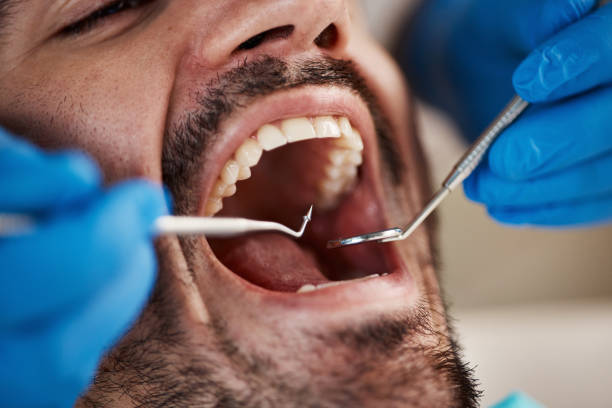 Best Emergency Tooth Extraction in Horseshoe Bay, TX
