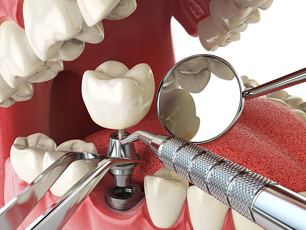 Best Emergency Denture Repair in Horseshoe Bay, TX